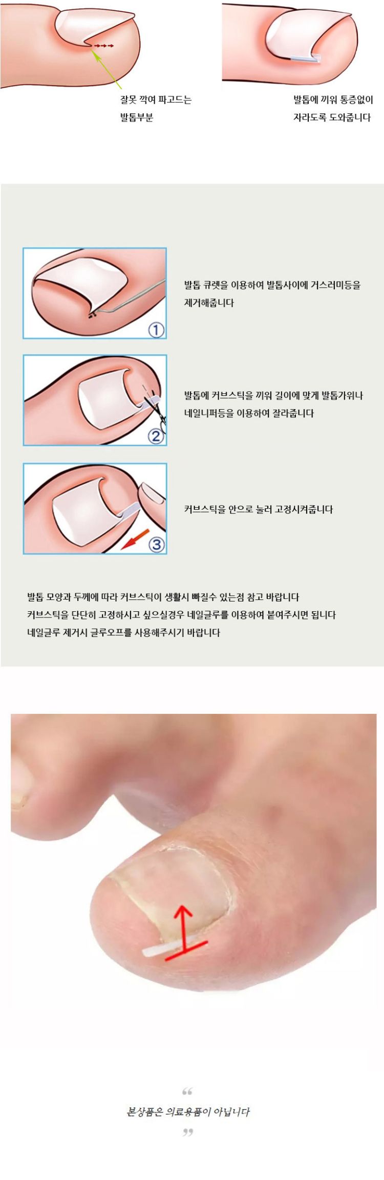 네일케어 문제성 발톱 셀프 관리 U자형 커브스틱 10p/내성발톱/발톱케어/문제성발톱/발톱큐렛/발톱캡/발톱